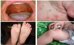 Bộ Y tế cảnh báo dịch tay chân miệng nguy hiểm gây tử vong ở trẻ em