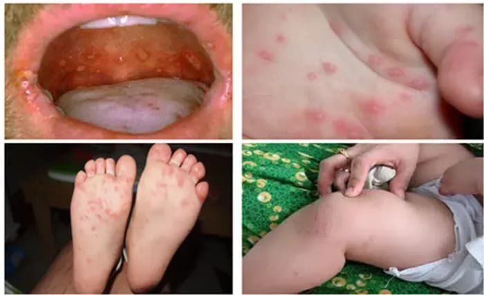 Bộ Y tế cảnh báo dịch tay chân miệng nguy hiểm gây tử vong ở trẻ em