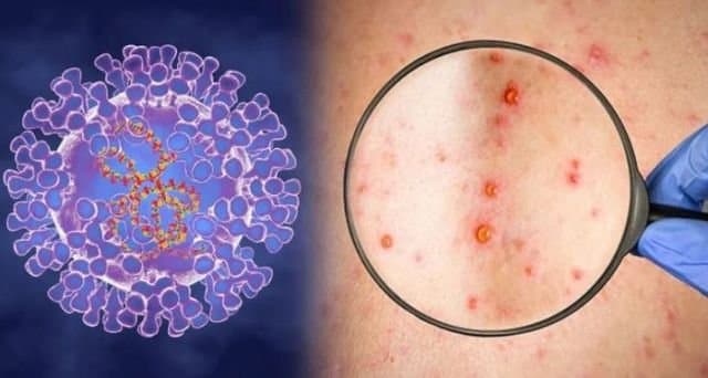 Phát hiện khác biệt di truyền trong virus đậu mùa khỉ năm 2022